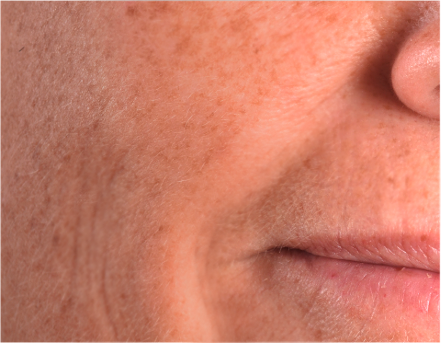First lines and skin aging