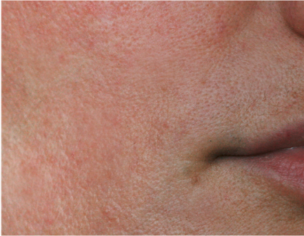 Sensitiv skin and redness