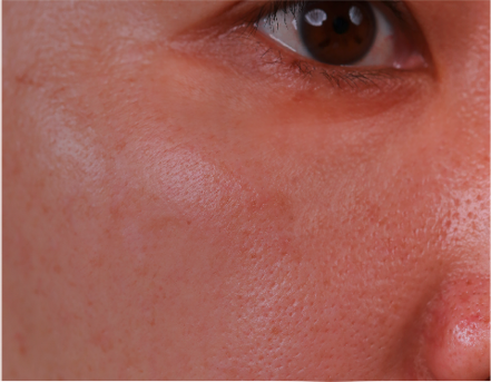 Dark circles and wrinkles under the eyes