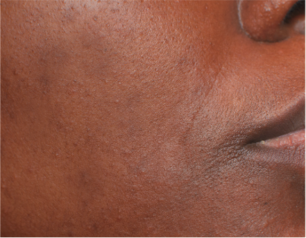 Pigmentation spots and uneven skin tone