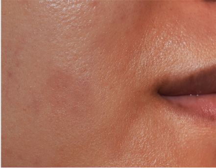 Blemish-prone skin