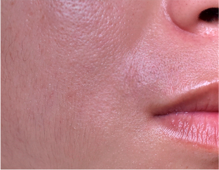 Oily skin and Combination skin