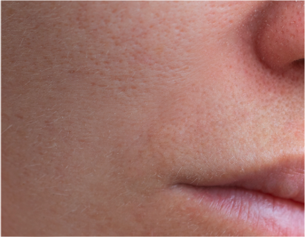 Dehydrated Skin