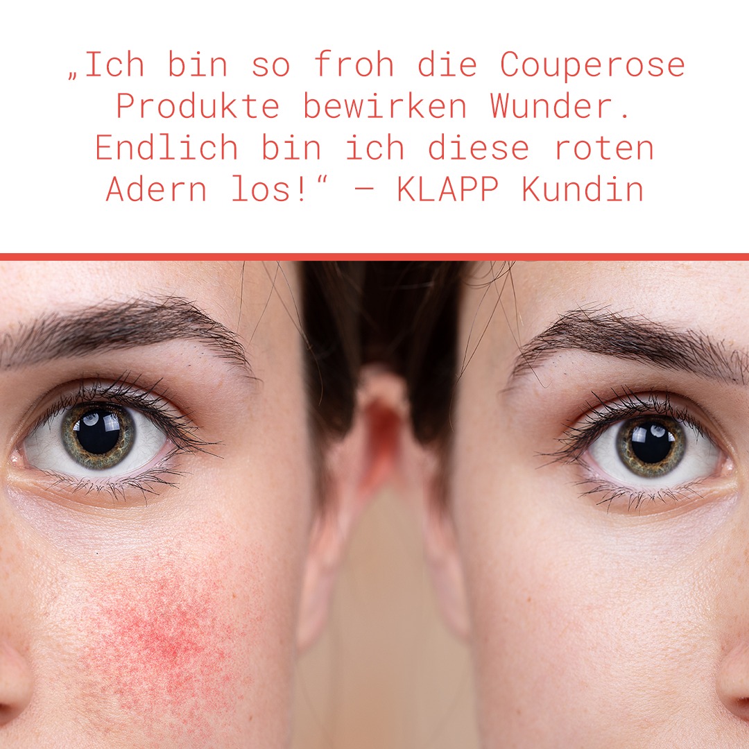 Unsere Kunden sind begeistert, du leidest unter Couperose? Dann teste auch du unsere Couperose Produkte und überzeuge dich selbst!

-

Our customers are delighted, do you suffer from couperose? Then test our couperose products and see for yourself!

#klappskincare #skincarescience #couperose #problemskin #skincare #madeingermany